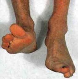 Exhibit: clinical photograph of bilateral feet showing right foot drop